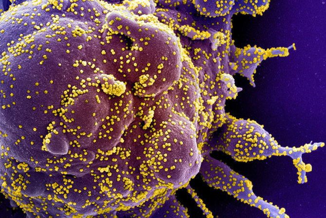 Mikrograf elektron pemindaian berwarna dari sel apoptosis (ungu) yang terinfeksi partikel virus SARS-COV-2 (kuning), juga dikenal sebagai novel coronavirus, diisolasi dari sampel pasien. (Reuters)